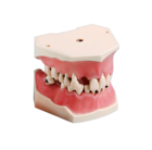 Tooth Set With Calculus A-PB ZC