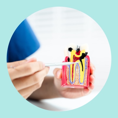 Durable Coronal Seal