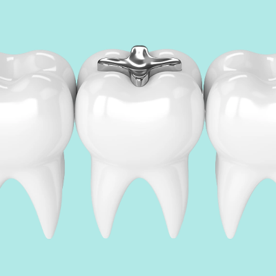 Amalgam Fillings in Dentistry